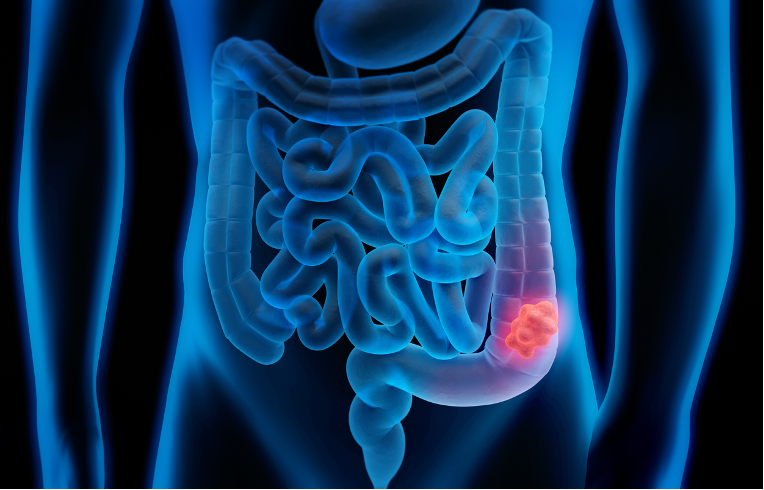 大腸癌のイメージ